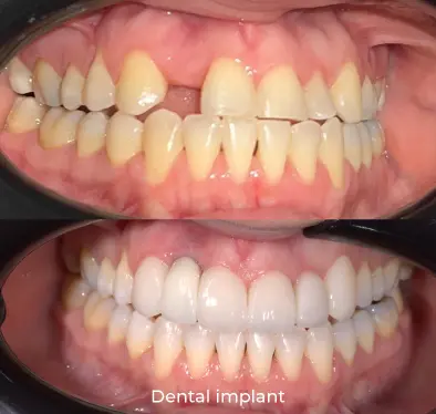 Dental Implant