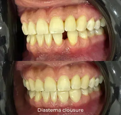 Diastema clousure