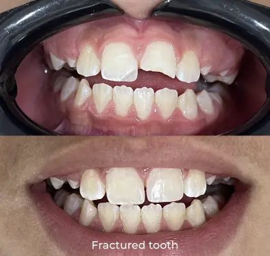 Fractured tooth
