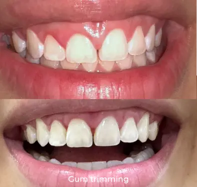 Gum trimming
